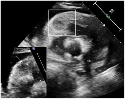 A case report: Null-cell cardiac lymphoma in an English bulldog